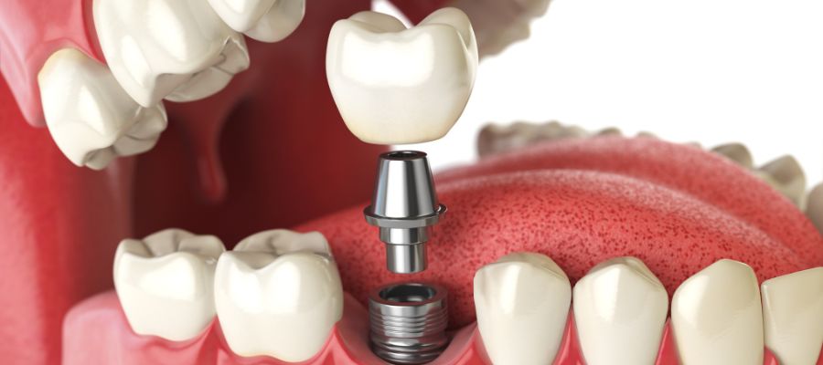couronne-sur-implant-dentaire-rouen-dr-jerome-adnot