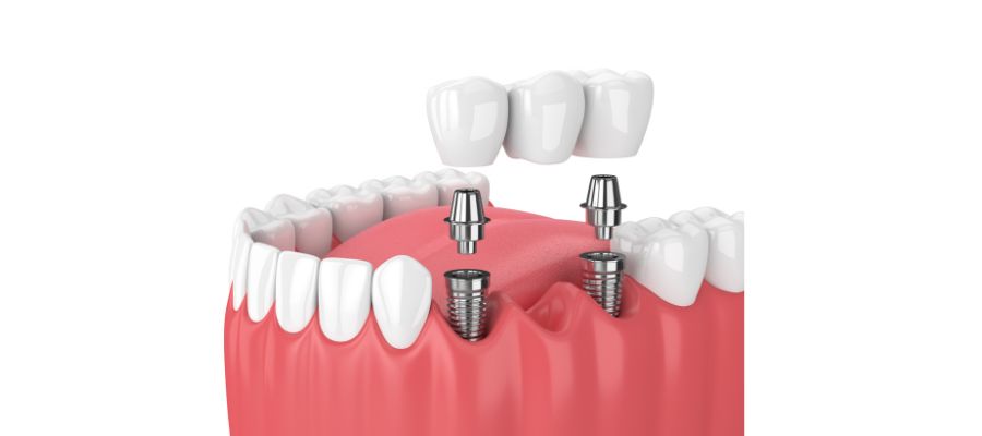 dr-jerome-adnot-implant-dentaire-rouen-bridge