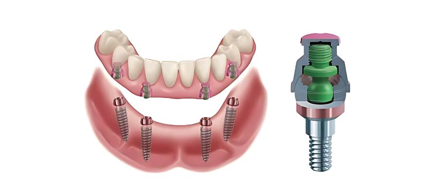 dr-jerome-adnot-implant-dentaire-rouen-prothese-stabilisee