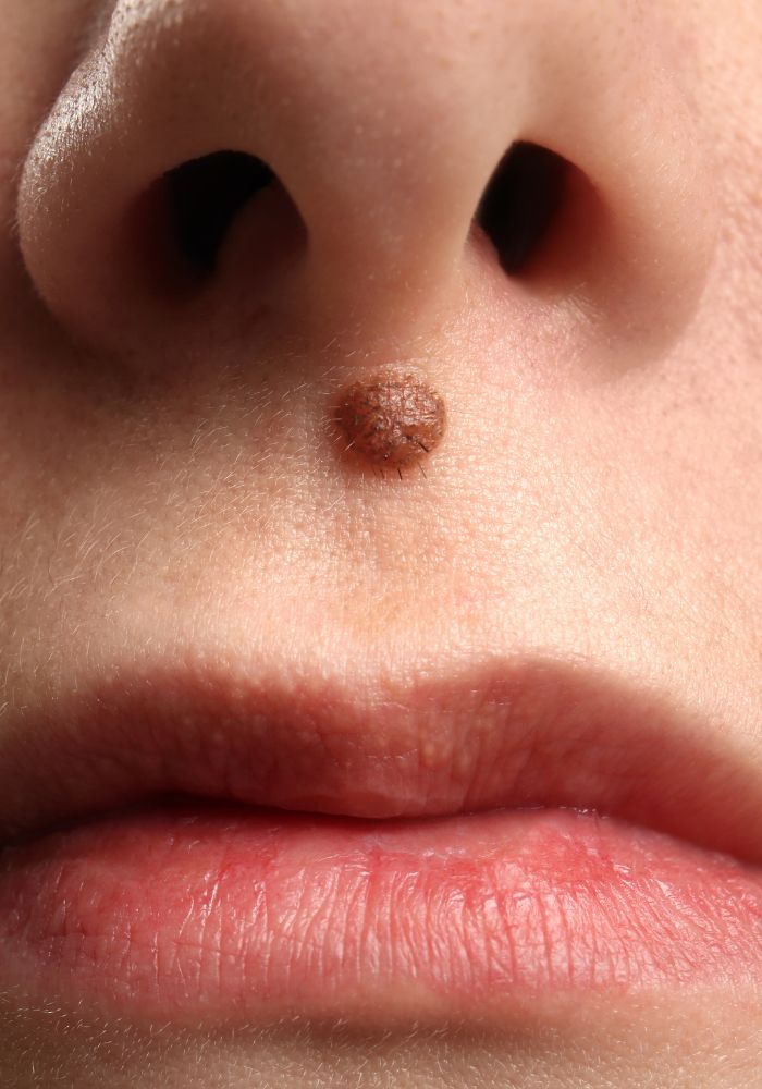 Exérèse de naevi - Rouen - Dr Jérôme Adnot