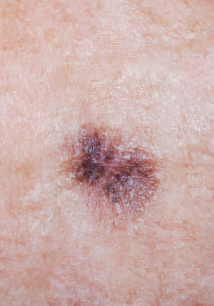 Exérèse de naevi - Rouen - Dr Jérôme Adnot